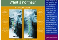 Normal Vs Abnormal Cervical Xray – Chiropractic Biophysics throughout Chiropractic X Ray Report Template